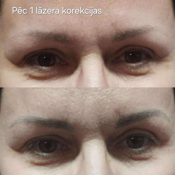 #permanentaisgrims#lāzerakorekcija#mikropigmentācija