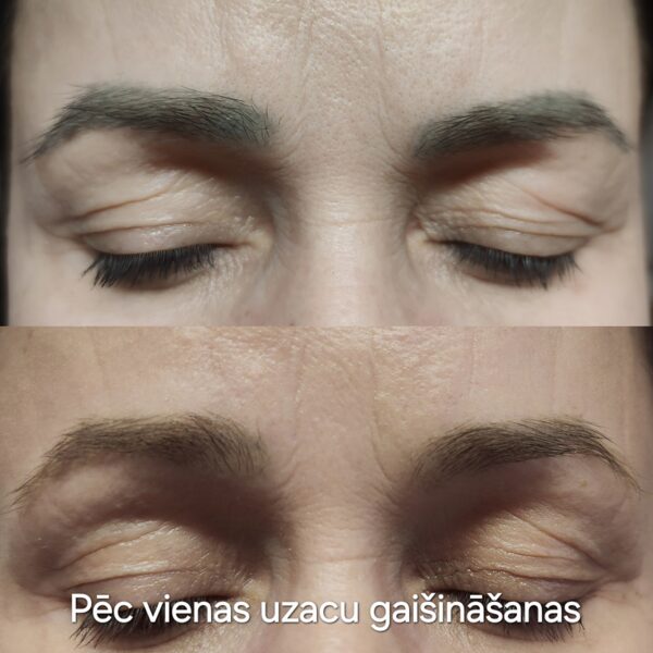 #lāzerkorekcija##uzacugaišināšana##uzacu korekcija