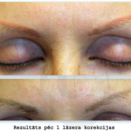 Lāzerkorekcija oranžas krāsas uzacīm