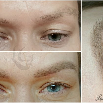 #permanentāsuzacis#healed after 1 treatment