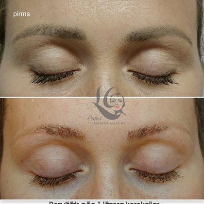 #lāzerakorekcija#laimacakstina