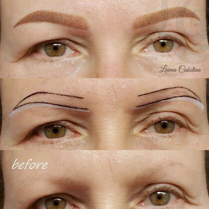 #permanentaisgrims##asimetrisku uzacu izlabošana