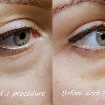 #permanenta##mikropigmentācija