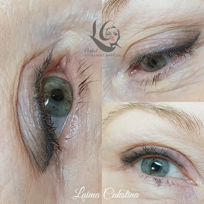 shading#healed after 1 procedure