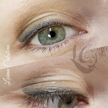 Eye permanent, healed