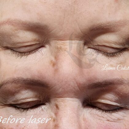 #laimacakstina##pirmentanoņemšana##lazerakorekcija