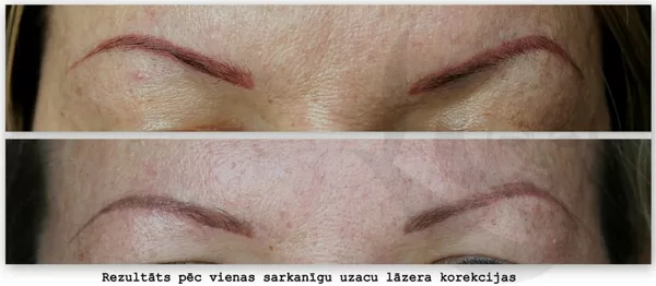 Sarkanbrūnu uzacu lāzera korekcija