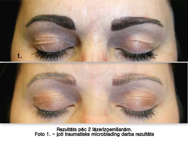 Lāzera korekcija microblading agresīvam rezultātam