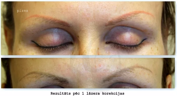 Lāzerkorekcija oranžas krāsas uzacīm