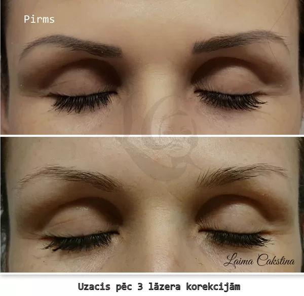 LĀZERA KOREKCIJA