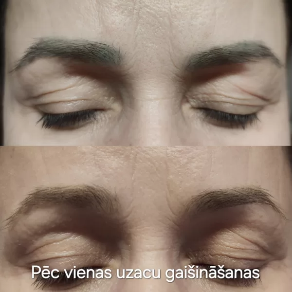 #lazerkorekcija#