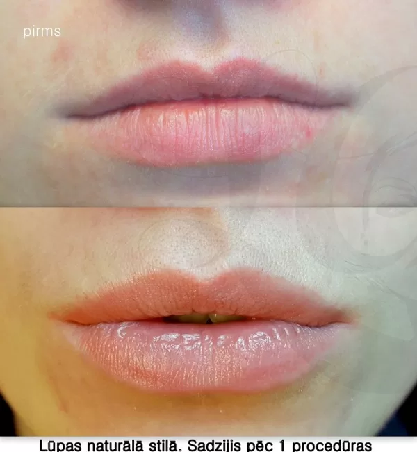 Lips micropigmentation, healed