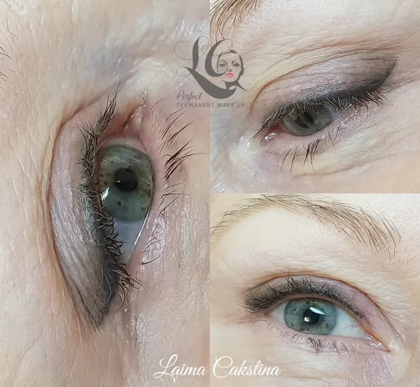 shading#healed after 1 procedure
